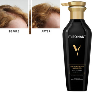Shampooing Traitant les Cheveux Abîmés par les Pellicules et la Perte de Cheveux Sévère, Nourrissant à la Kératine pour Cheveux Bouclés - Product Image 2