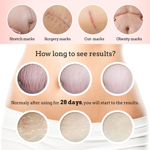 Fórmula herbal natural omy Lady, eliminador permanente de cicatrices de acné, crema antiestrías, personalizado gratis - Product Image 4
