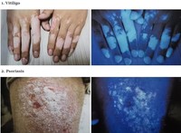Taşınabilir Tıbbi Wood Lambası, Cilt Lekelerinin Analizi için Vitiligo Görüntüleri Yakalamak İçin Kullanılır.
