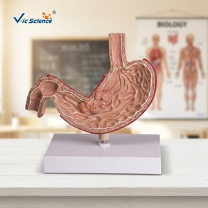 Modelo de Estómago Patológico Humano con Úlcera Cancerosa e Inflamación, para Educación del Paciente, Maniquí Médico - Product Image 3