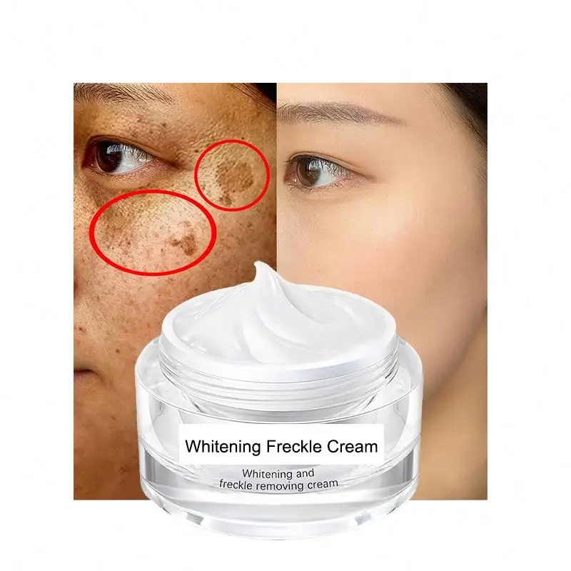 Estratto di erbe lentiggine macchia scura rimozione della migliore crema sbiancante per la pelle per la pelle asiatica