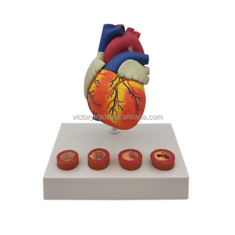 V-GF211209-1 Menselijk Hart Model 4 Stadia Vasculaire Slagader Pathologische Stage Hart Anatomisch Model