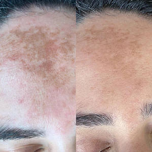 S Strongest 99% Spongilla Spicules Bio Microneedling Therapy Algas <span class=keywords><strong>Peeling</strong></span> Eliminación <span class=keywords><strong>de</strong></span> <span class=keywords><strong>manchas</strong></span> Recuperación <span class=keywords><strong>DE</strong></span> <span class=keywords><strong>LA</strong></span> PIEL Reduce <span class=keywords><strong>la</strong></span> hiperpigmentación - Product Image 6