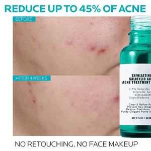 Acide salicylique acide acné sérum rétrécir les Pores exfoliant supprimer l'acné points noirs soins de la peau sérum pour le visage - Product Image 3