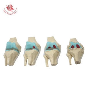Artrose Kniegewricht <span class=keywords><strong>Model</strong></span> Frt033 Levensgrote Transparante Ligament 4 Stadium Pathologische Ontwikkeling Medisch Anatomisch <span class=keywords><strong>Model</strong></span> - Product Image 3