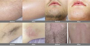 2025 Best Selling Ce <strong>Approved</strong> 1200w 1800w Laser <strong>Diode</strong> 755 808 1064nm <strong>Diode</strong> Laser Hair Removal Machine - Product Image 3