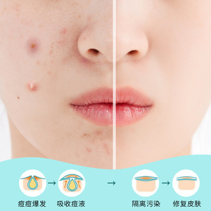 Patchs anti-boutons personnalisés en forme de dessin animé, emballage individuel, traitement de l'acné pour peaux grasses et mixtes - Product Image 5