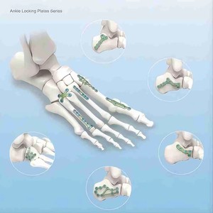 Y-Shaped Titanium Micro Locking Plates Maxillofacial <strong>Implants</strong> &amp; <strong>Interventional</strong> <strong>Materials</strong> with Locking Plate - Product Image 2