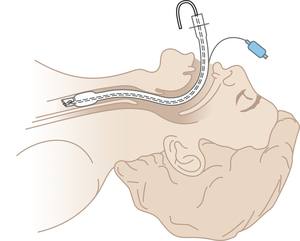 Одноразовая Эндотрахеальная трубка из ПВХ с высоким объемом манжеты низкого давления по заводской цене - Product Image 5