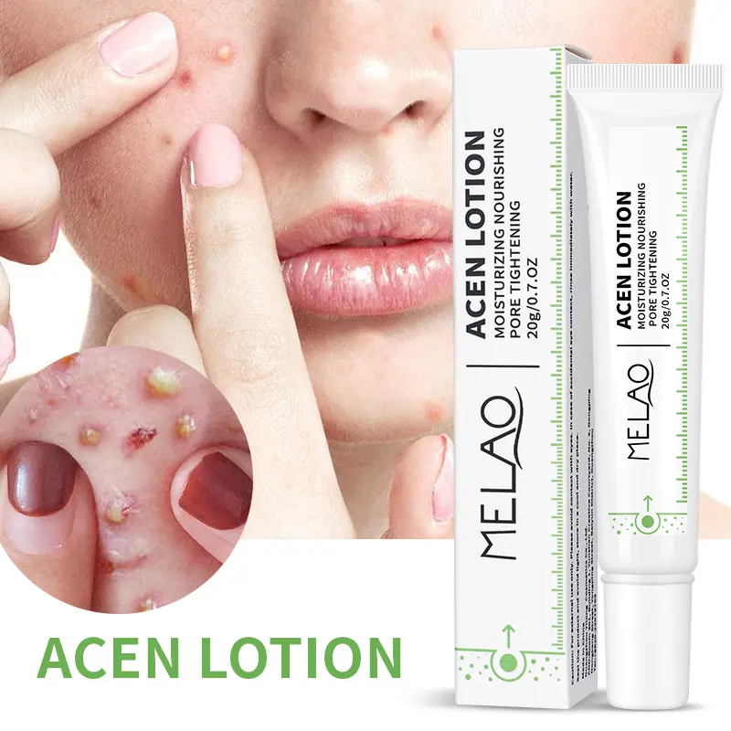 Benutzer definierte OEM Travel Hautpflege-Sets Akne Essenz Feuchtigkeit spendende Akne Cure Lotion Reparatur Serum Pickel Patch Anti Akne Creme