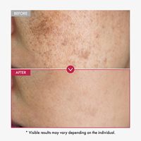Nouvelle version 10% Niacinamide 4% Acide Tranexamique Essence Traitement Anti-Acné 30ml Efficace pour Atténuer la Mélanine