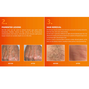 Épilation au <span class=keywords><strong>laser</strong></span> NdYag en <span class=keywords><strong>dermatologie</strong></span> médicale, 1064 nm, à impulsions longues, usage commercial, garantie de 2 ans, qualité garantie - Product Image 5