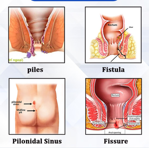Mesin pembasmi ambeien, mesin pengobatan ambeien, pengobatan Laser Excision, ambeien, penghilang ambeien dan ambeien - Product Image 2