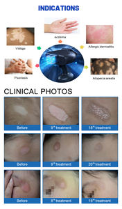 2025 Produk Terlaris 308Nm Output Cahaya Excimer Panjang Gelombang Tunggal melalui Medium Xecl Perawatan Tanpa Rasa Sakit - Product Image 5