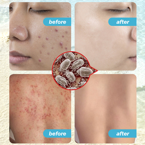 Eliminación de espinillas, poros, tratamiento para el acné, jabón hidratante de glicerina, barra de jabón de sal marina blanqueadora - Product Image 5