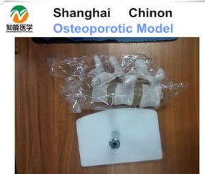 Humanos osteoporóticas <span class=keywords><strong>esqueleto</strong></span> óseo anatómico modelo - Product Image 2