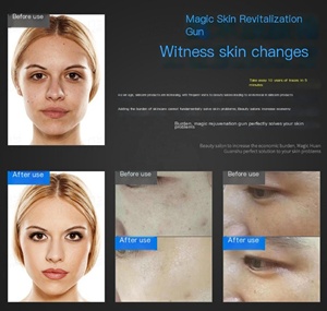 DUOZI-Pistola Mágica de Estiramiento Facial, Pistola sin Aguja para Estiramiento Facial, Terapia de Gas CO2, Piel Congelada, Crioterapia - Product Image 4