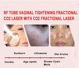 Portable CO2 Fractional Laser <b>Machine</b> Skin Tightening <b>Stretch</b> Mark Removal Cutting Women Private Vagine Tightening Laser <b>Machine</b> - Product Image 2