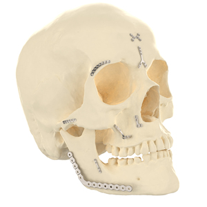 CANWELL Titanium Micro <span class=keywords><strong>Mini</strong></span> Mandibulaire Plaat Orthopedisch Implantaat Botchirurgie Maxillofaciale Vergrendelplaten Ziekenhuisgebruik CE - Product Image 2