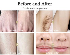 <span class=keywords><strong>2025</strong></span> New arrivals 3 trong 1 tẩy lông bằng laser alexandrite Máy tẩy lông bằng laser giá - Product Image 2