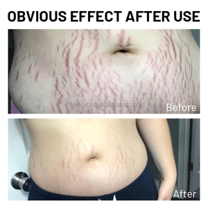 Nhãn Hiệu Riêng Loại Bỏ Vết Rạn Da Điều Trị Tự Nhiên Cho Kem Đánh Dấu Co Giãn Cơ Thể Pergnancy - Product Image 5