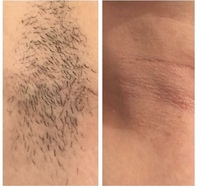 Meilleure vente 2024 nouvel équipement de beauté en titane glace 755/808/1064nm Diode Laser épilation rajeunissement de la peau semi-conducteur