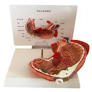 แบบจำลองการเปลี่ยนแปลงของกระเพาะอาหารในมนุษย์ สำหรับการสอนทางการแพทย์ด้านโรค<span class=keywords><strong>กระเพาะ</strong></span>อาหารและระบบทางเดินอาหาร - Product Image 3