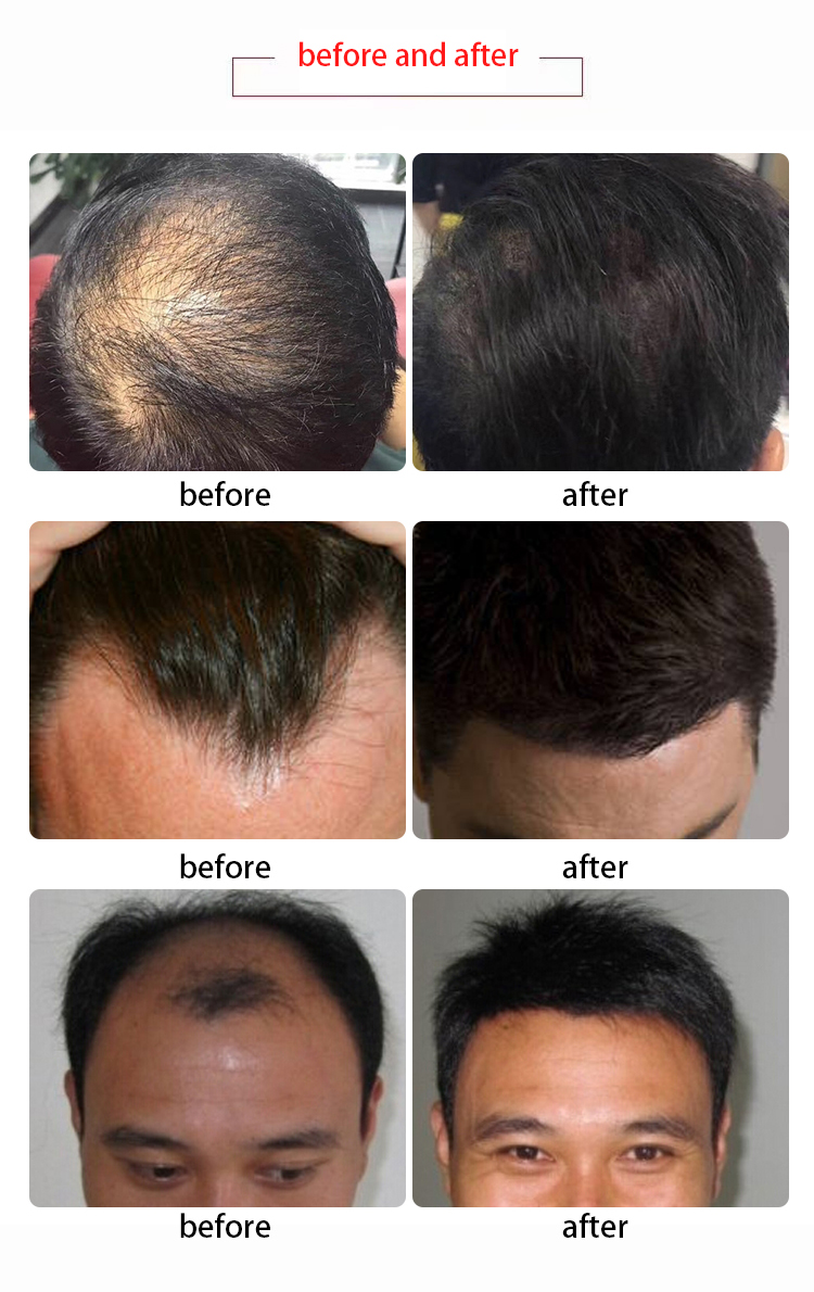 LLLT Laser Anti-Hair Loss Treatment Equipment 650Nm Scalp Massage Led Laser Device For Hair Growth With Hair Follicle Detection