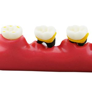 Modelo de Dientes Tipodonto para Demostración del Progreso de la Enfermedad Periodontal, Categoría Patología, para Enseñanza, Estudio y Demostración - Product Image 5