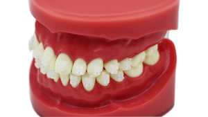 Keramische zelfligierende beugels orthodontische transparante Roth MBT 022 tandheelkundige beugels voor mondtherapie apparatuur accessoires - Product Image 4