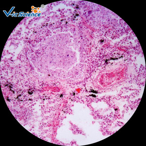 Lung abscess biological section, medical histology, <b>microscope</b> for teaching and research, medical school laboratory. - Product Image 1