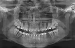 En Yeni Yılımda MEYER SS-X9010D Pro-3DE CBCT Panoramik Sefalometrik BT 3'ü 1 Arada Diş Kliniği Geniş Görüntü Alanlı Görüntüleme - Product Image 6