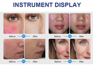 Système laser à diode esthétique 980 nm pour les problèmes vasculaires, les champignons, la douleur, le rajeunissement, l'<span class=keywords><strong>eczéma</strong></span> et le traitement du mélasma (ice hammer) - Product Image 6