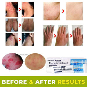 Extracción de hierbas chinas Dermatitis Psoriasis Ungüento Picazón Peeling Eczema Ungüento antifúngico Cuidado DE LA SALUD - Product Image 4