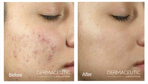 Nouveau produit 2026 : Lait exfoliant Dermaceutique pour le soin des cicatrices d'acné et des soins du visage – Vente chaude - Product Image 3