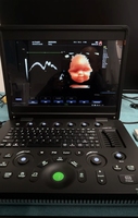 Système de diagnostic par ultrasons Doppler couleur 3D 4D Machine à ultrasons couleur pour ordinateur portable avec fonction PW CW