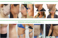 Liposuccion Vaser Haute puissance 30w Diode Laser 980nm Lipo Endo Laser Lift Lipolyse Machine