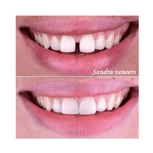 Best Verkopende Machine Cosmetische Prothese Tandheelkundige Clip Kit Porseleinen Composiet Aangebracht Op Oppervlakte Defect Fineer Tand