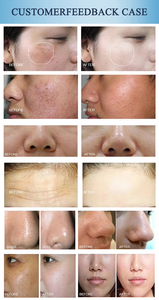 Pièce à main hydrodermabrasion Machine de microdermabrasion 10 en 1 avec oxygénothérapie et analyse de la peau pour clinique de beauté - Product Image 5
