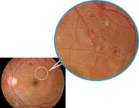 Caméra de fond d'œil non mydriatique Aps-Aer de qualité supérieure pour l'ophtalmologie