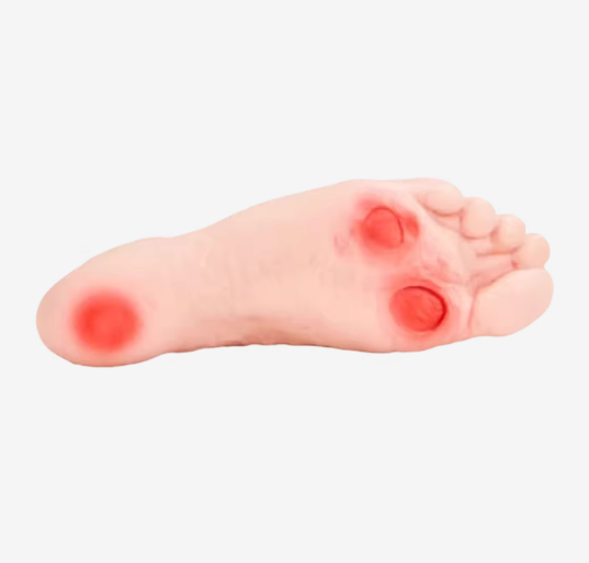 diabetic foot