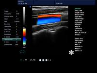 Meilleur Prix DW-L5 Doppler Couleur 4D Machine À Ultrasons Pour Ordinateur Portable Ordinateur Portable machine à ultrasons Doppler couleur