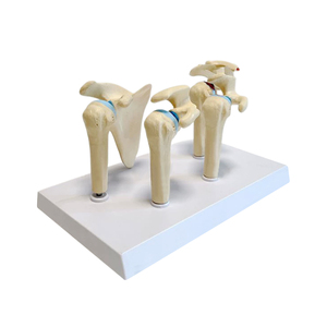 Modello di Articolazione della Spalla Umana, Osso Scapolare, Patologia, per Medici e Pazienti, Dimostra Reumatismo, Periartrite della Spalla, Ortopedia - Product Image 2