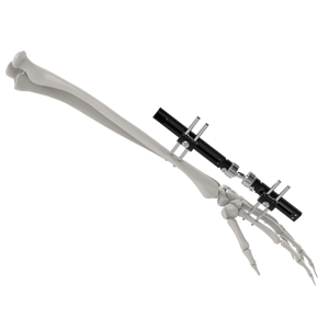 CANWELL Wrist External Fixator Small Bones Fracture Fixation Mini External Fixator Orthopedic Implant Phalanges and <strong>Metacarpals</strong> - Product Image 1