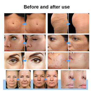 Appareil Portable R1F pour le Visage : Marteau de Glace Anti-Rides et Anti-Vergetures - Product Image 3