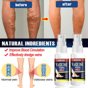 <strong>Best</strong> Sellers Herbal Varicose Vein Spray Treat Vasculitis Phlebitis Pain Relief <strong>Cream</strong> Spots OEM ODM - Product Image 2