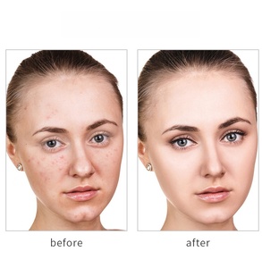 แผ่นปิดสิวไฮโดรคอลลอยด์แบบใส แผ่นปิดรอย<span class=keywords><strong>สิว</strong></span> สติ๊กเกอร์ปิดสิวแบบไมโครนีดเดิล สำหรับใบหน้าและผิว - Product Image 3