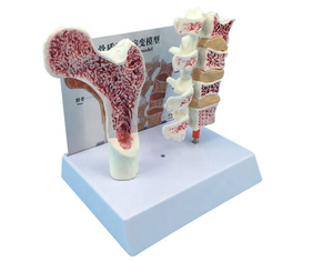 แบบจำลองพยาธิวิทยาโรคกระดูกพรุน แบบจำลองกระดูกต้นขาและกระดูกสันหลังส่วนเอว แบบจำลองพยาธิวิทยาโรคกระดูกเสื่อม 4 ขั้นตอน - Product Image 1