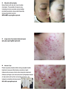 Kit de Exfoliación con Algas para Eliminar el Acné con Esponja de Cuidado Posterior a la Piel, <span class=keywords><strong>Peeling</strong></span> Bio con Agujas de Algas, <span class=keywords><strong>Peeling</strong></span> <span class=keywords><strong>Facial</strong></span> Verde Anti-acné y Anti-manchas - Product Image 4