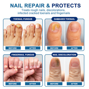 Crema para Eliminar Hongos en las Uñas de los Pies, Suero Reparador Antifúngico para el Cuidado de las Uñas - Product Image 5